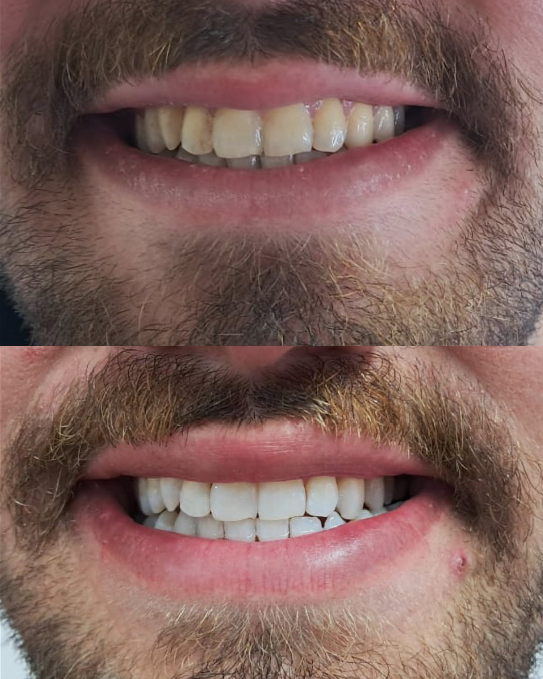 Zbardhja e Dhëmbëve